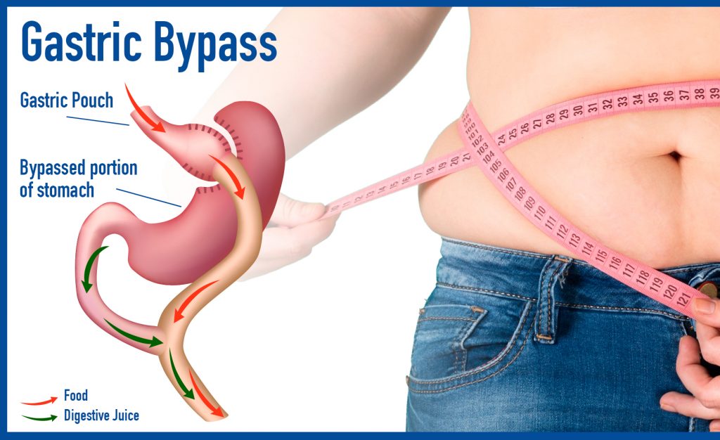 Am I A Bariatric Surgery Candidate?