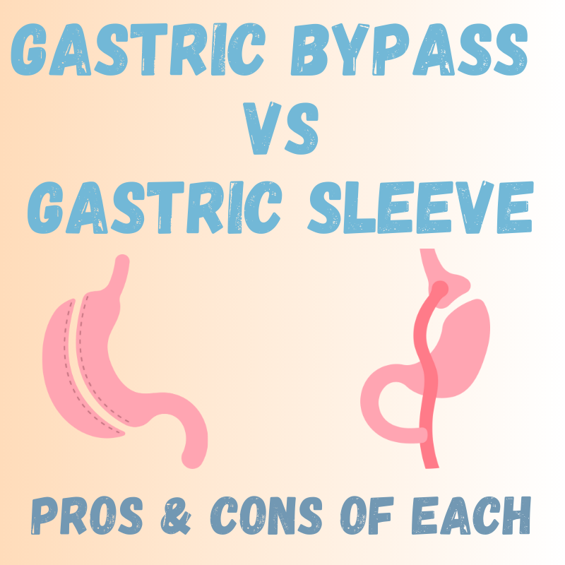 Gastric Sleeve vs Gastric Bypass: Pros & Cons?